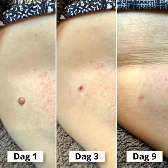 Dermaskin Pro™ - Den smarta lösningen mot hudflikar